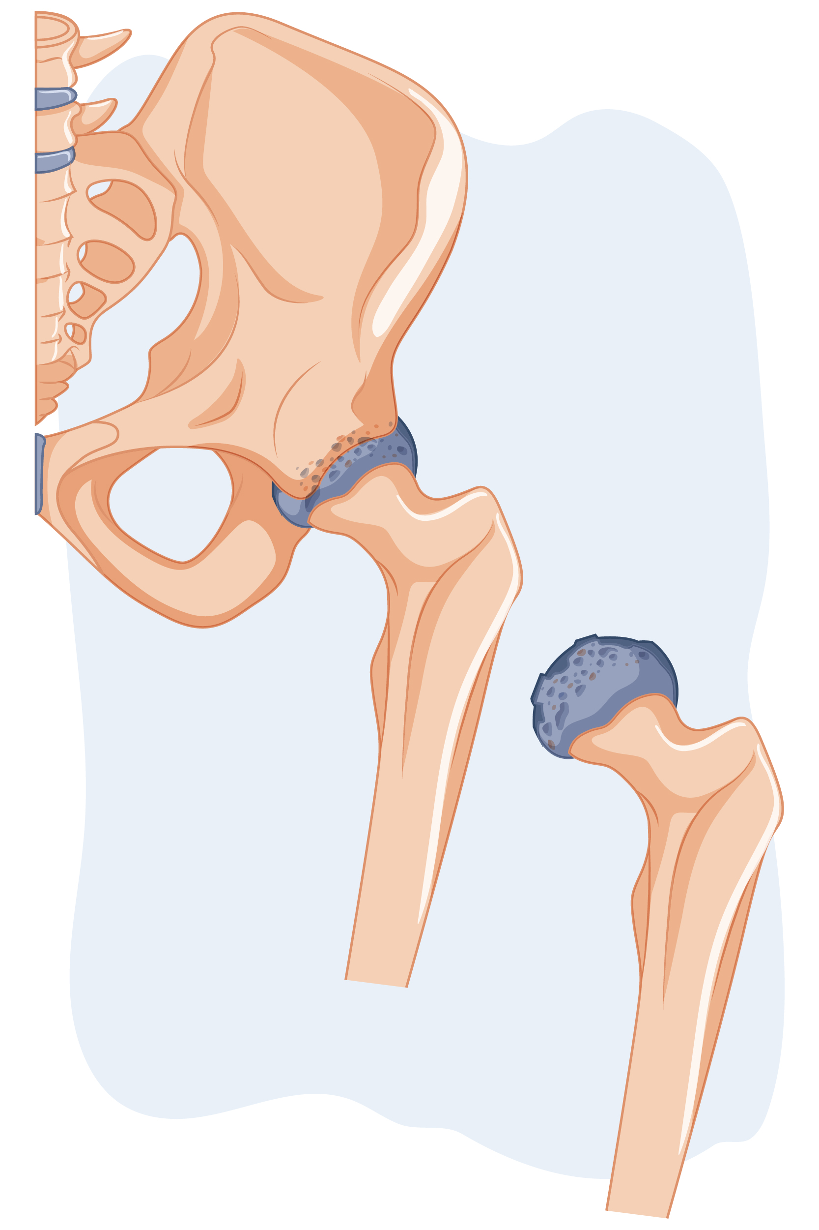 Radiografía de artrosis de cadera — degeneración del cartílago articular
