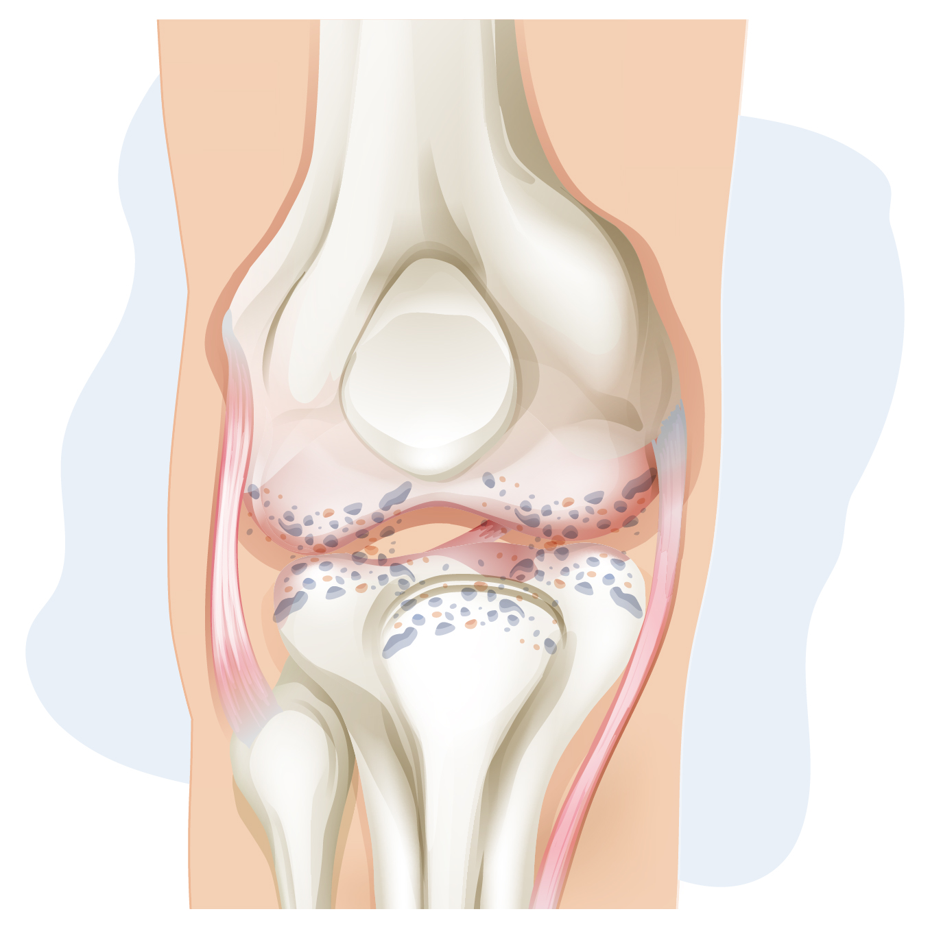 Ilustración de una rodilla afectada por artrosis