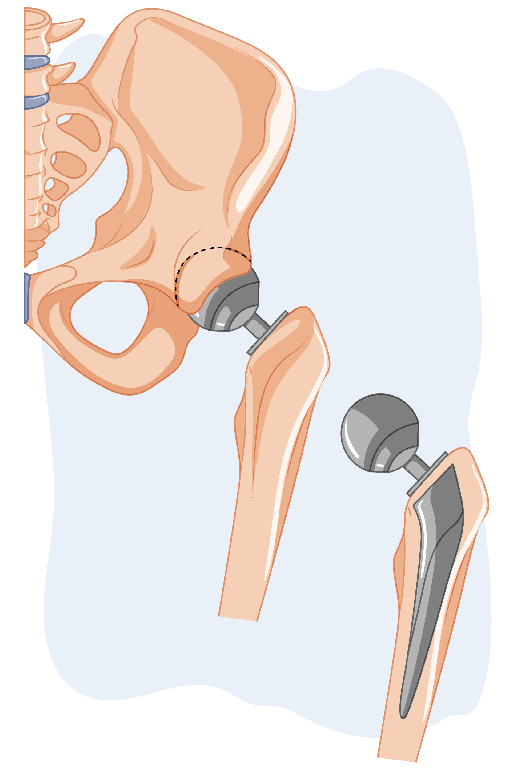 Componentes de una prótesis de cadera — implante articular de reemplazo