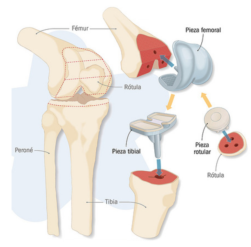 Componentes de una prótesis de rodilla — reemplazo articular total