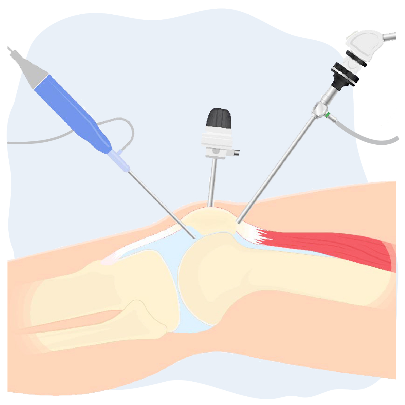 Artroscopia de rodilla