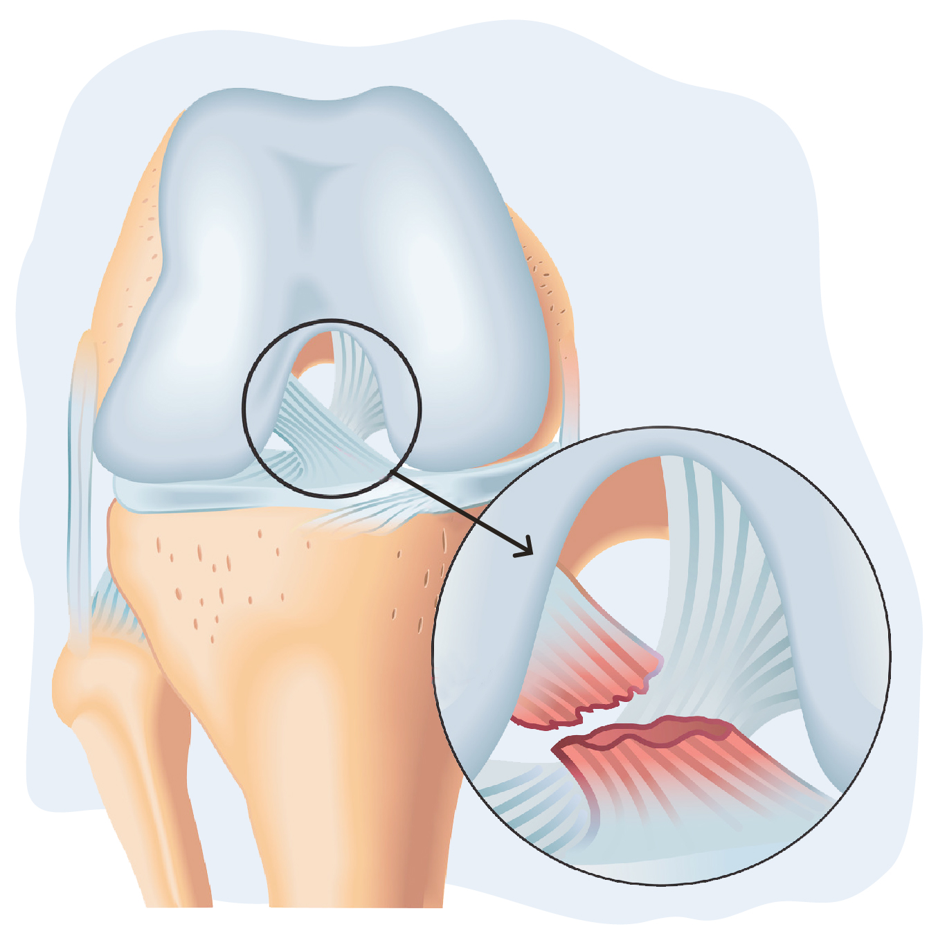 Lesión del ligamento Cruzado de la rodilla