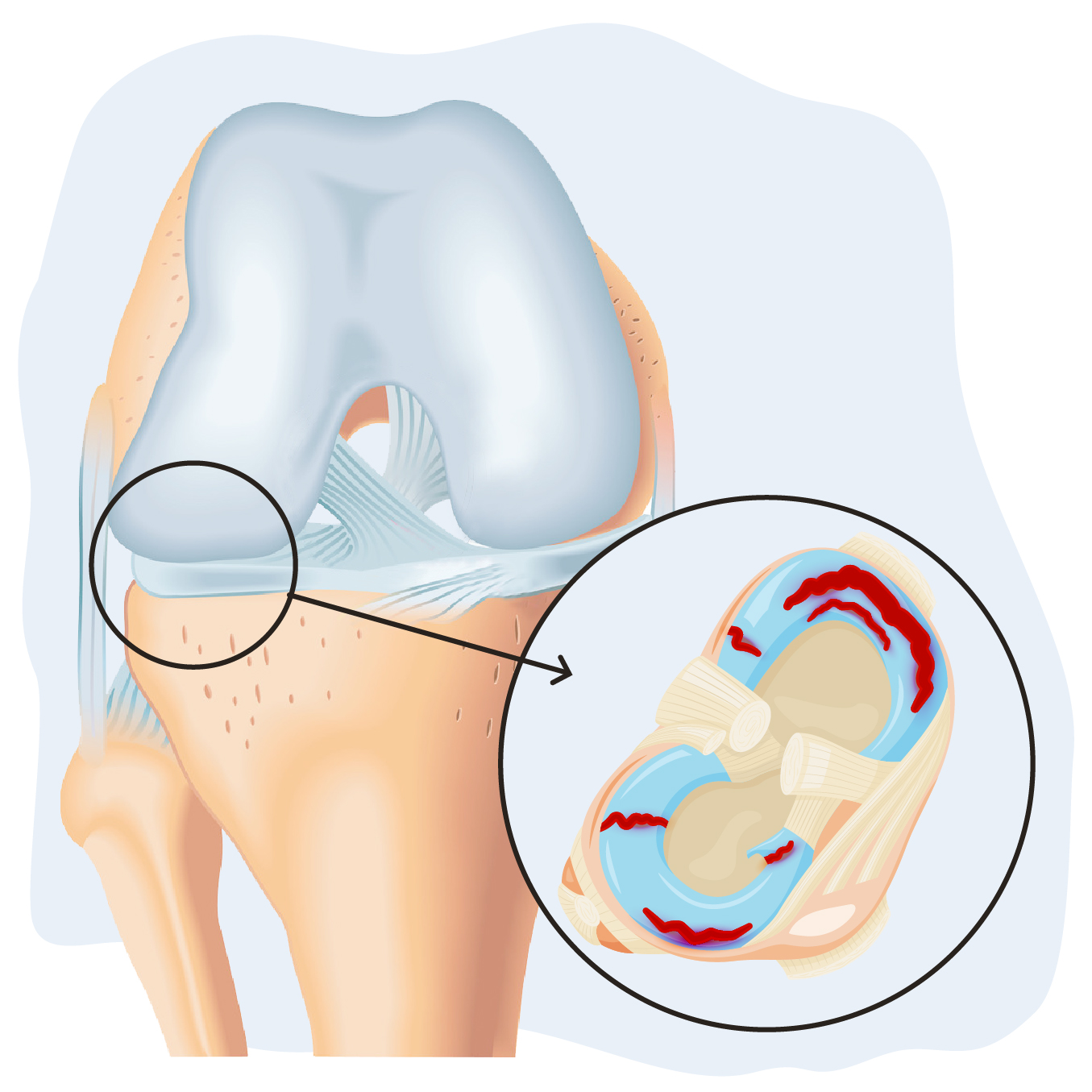 Lesion meniscos de la rodilla